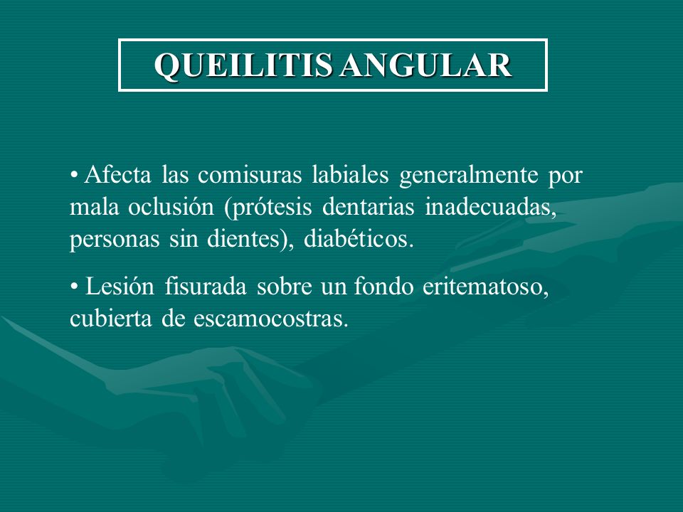 QUEILITIS ANGULAR Afecta las comisuras labiales generalmente por mala oclusión (prótesis dentarias inadecuadas, personas sin dientes), diabéticos.