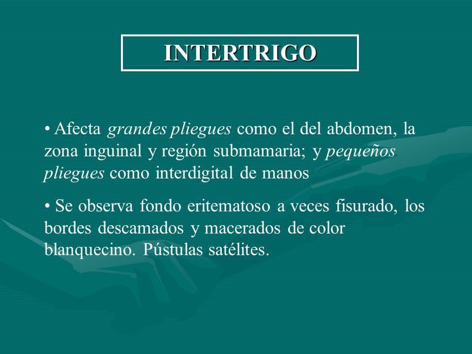 INTERTRIGO Afecta grandes pliegues como el del abdomen, la zona inguinal y región submamaria; y pequeños pliegues como interdigital de manos.