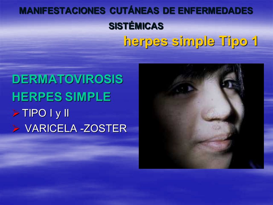 DERMATOVIROSIS HERPES SIMPLE TIPO I y II VARICELA -ZOSTER