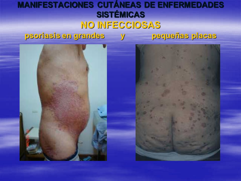 MANIFESTACIONES CUTÁNEAS DE ENFERMEDADES SISTÉMICAS NO INFECCIOSAS psoriasis en grandes y pequeñas placas