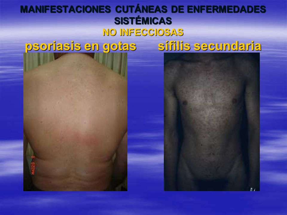 MANIFESTACIONES CUTÁNEAS DE ENFERMEDADES SISTÉMICAS NO INFECCIOSAS psoriasis en gotas sífilis secundaria