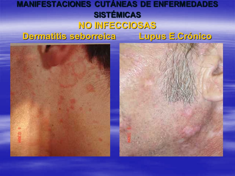 MANIFESTACIONES CUTÁNEAS DE ENFERMEDADES SISTÉMICAS NO INFECCIOSAS Dermatitis seborreica Lupus E.Crónico