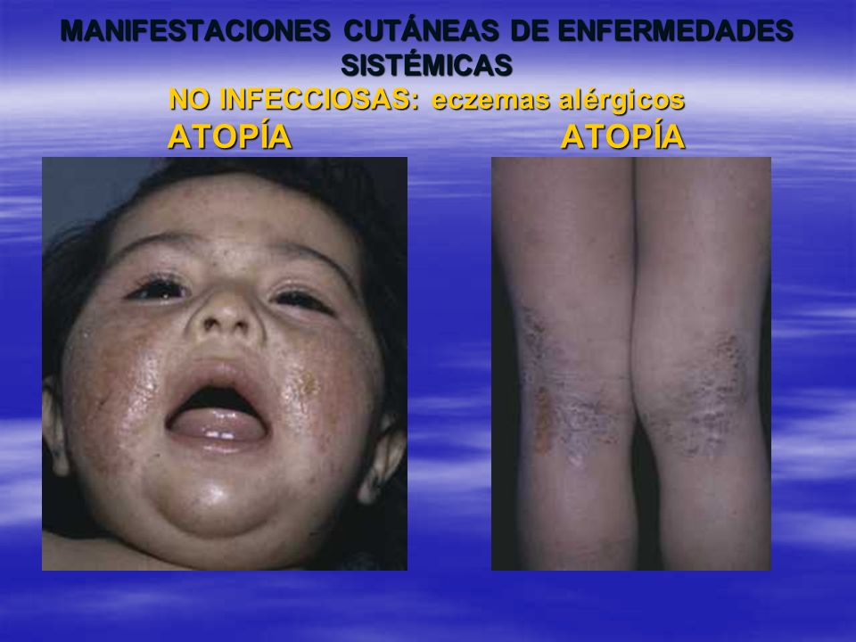 MANIFESTACIONES CUTÁNEAS DE ENFERMEDADES SISTÉMICAS NO INFECCIOSAS: eczemas alérgicos ATOPÍA ATOPÍA