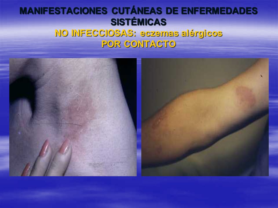 MANIFESTACIONES CUTÁNEAS DE ENFERMEDADES SISTÉMICAS NO INFECCIOSAS: eczemas alérgicos POR CONTACTO