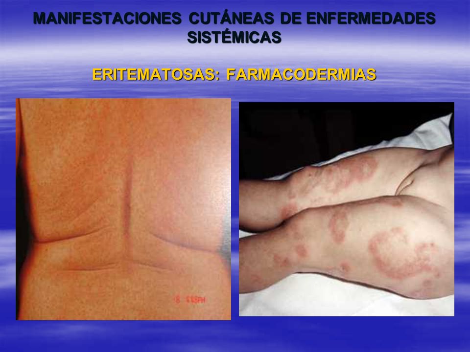 MANIFESTACIONES CUTÁNEAS DE ENFERMEDADES SISTÉMICAS ERITEMATOSAS: FARMACODERMIAS