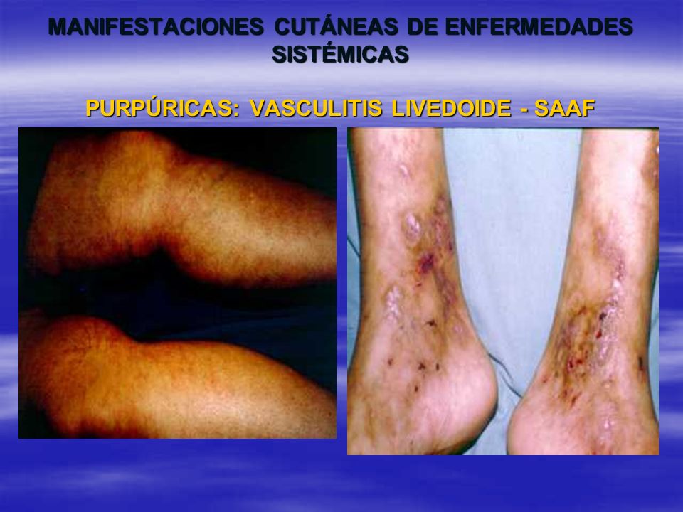 MANIFESTACIONES CUTÁNEAS DE ENFERMEDADES SISTÉMICAS PURPÚRICAS: VASCULITIS LIVEDOIDE - SAAF