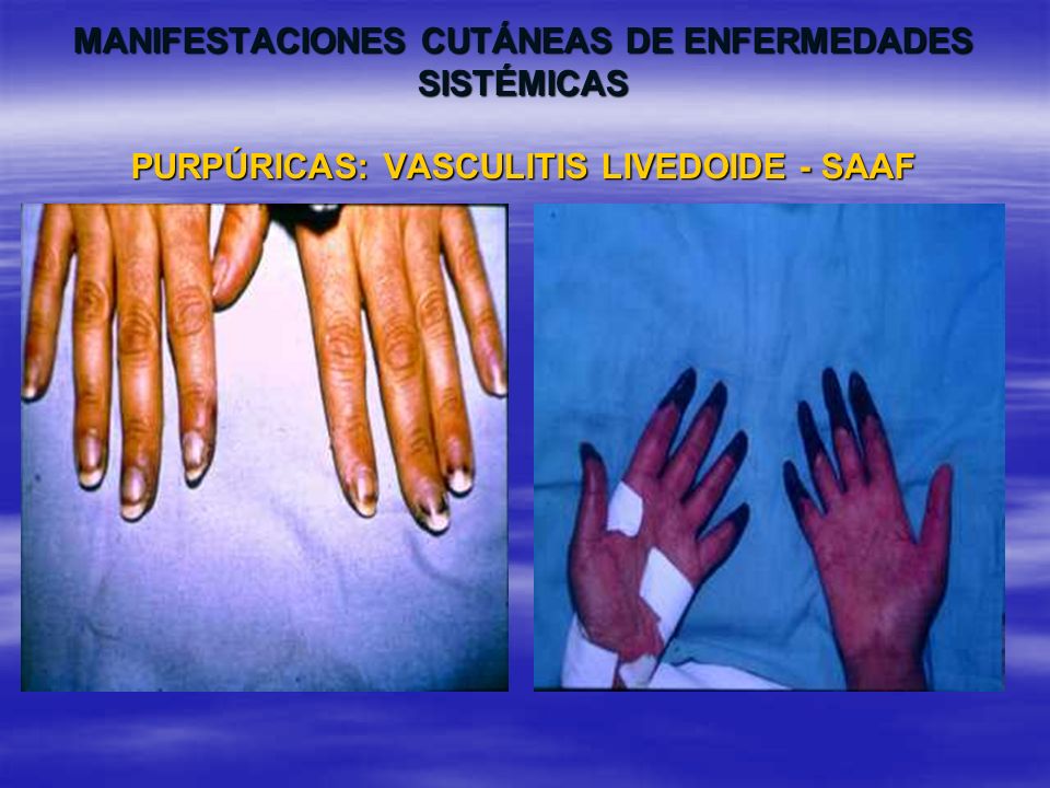 MANIFESTACIONES CUTÁNEAS DE ENFERMEDADES SISTÉMICAS PURPÚRICAS: VASCULITIS LIVEDOIDE - SAAF