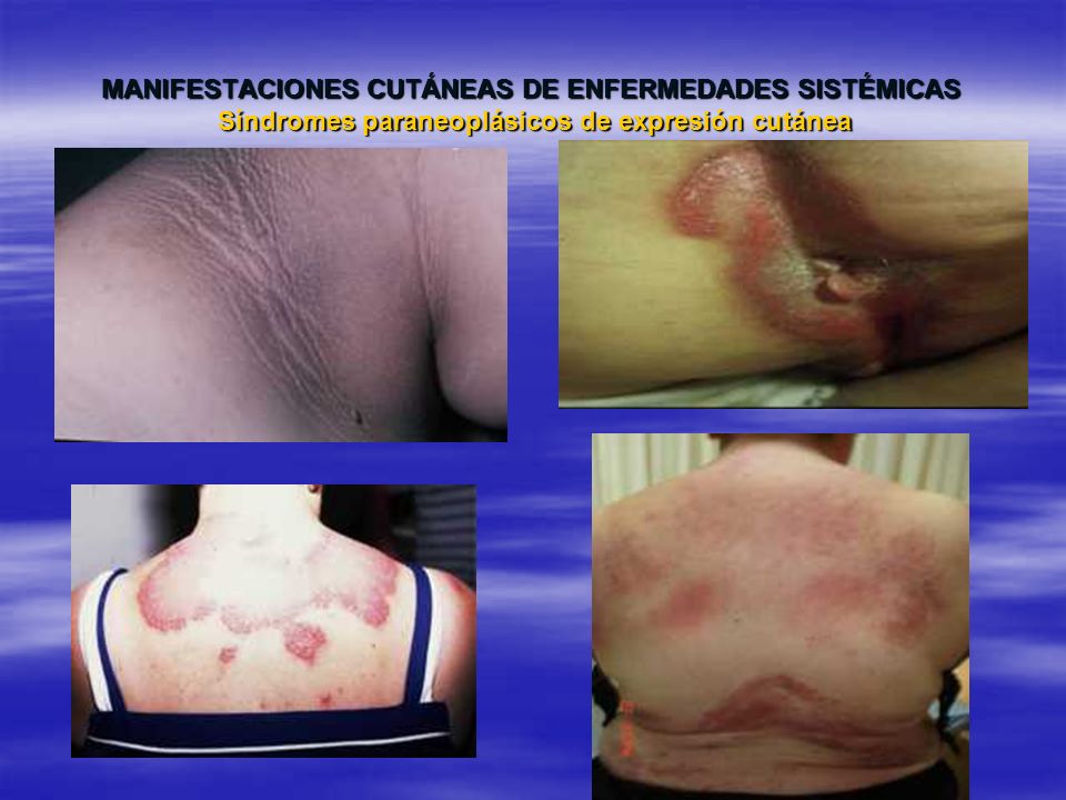 MANIFESTACIONES CUTÁNEAS DE ENFERMEDADES SISTÉMICAS Síndromes paraneoplásicos de expresión cutánea