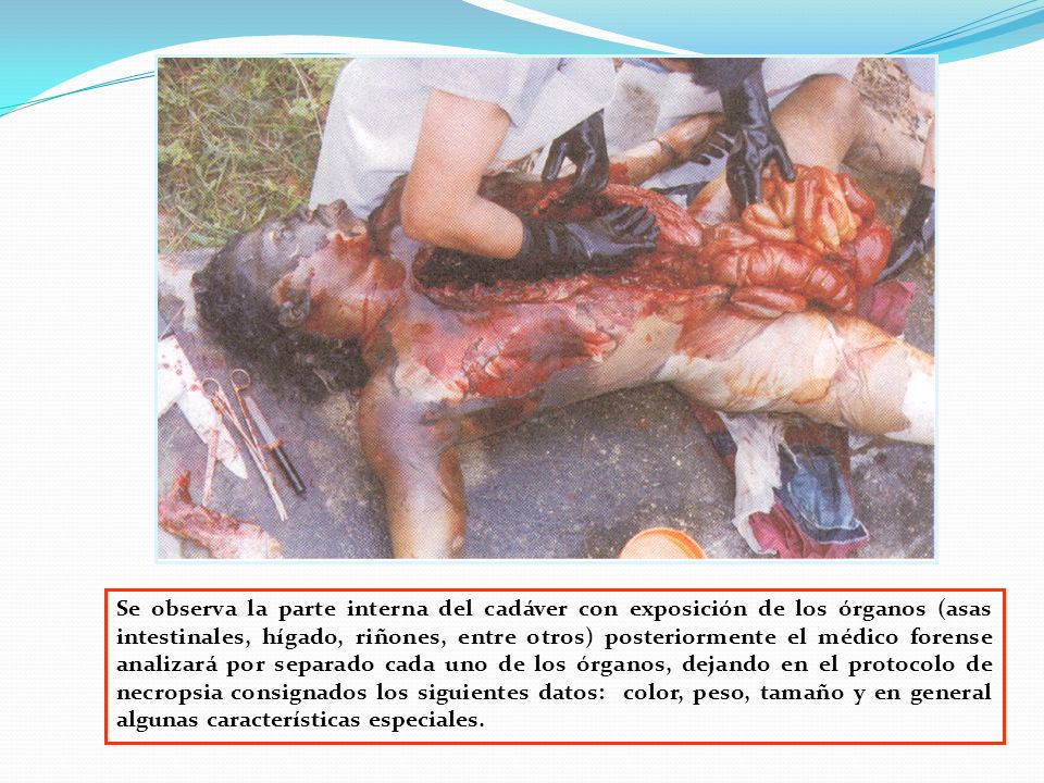 Se observa la parte interna del cadáver con exposición de los órganos (asas intestinales, hígado, riñones, entre otros) posteriormente el médico forense analizará por separado cada uno de los órganos, dejando en el protocolo de necropsia consignados los siguientes datos: color, peso, tamaño y en general algunas características especiales.