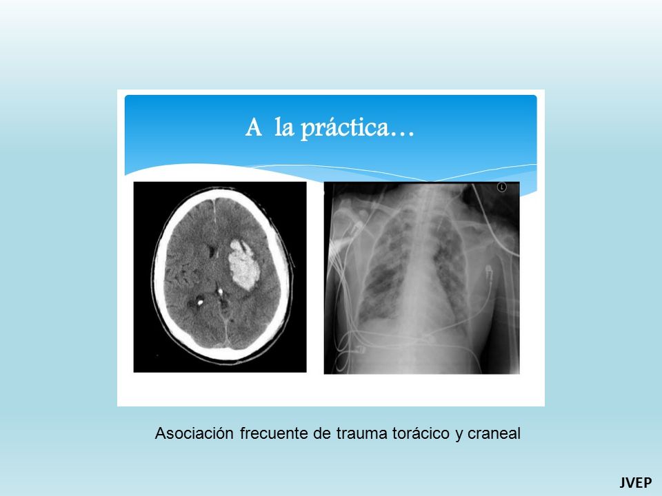 Asociación frecuente de trauma torácico y craneal