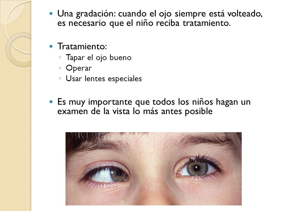 Una gradación: cuando el ojo siempre está volteado, es necesario que el niño reciba tratamiento.