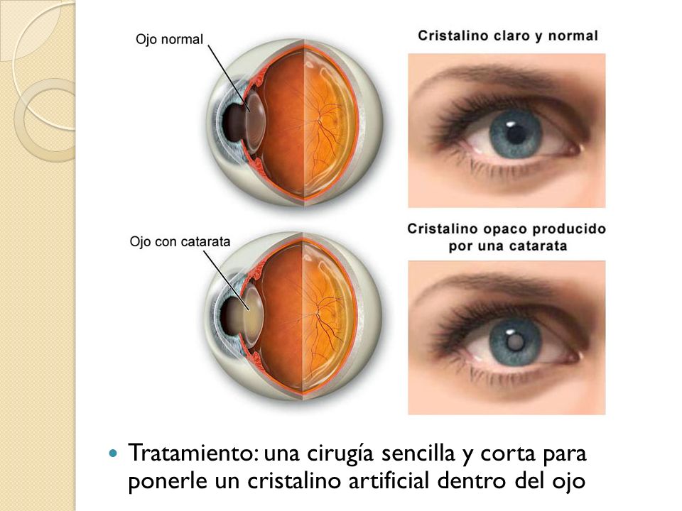 Tratamiento: una cirugía sencilla y corta para ponerle un cristalino artificial dentro del ojo