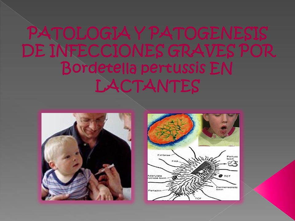 PATOLOGIA Y PATOGENESIS DE INFECCIONES GRAVES POR Bordetella pertussis EN LACTANTES