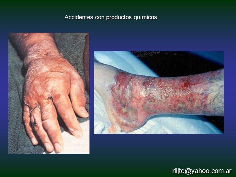 Accidentes con productos químicos