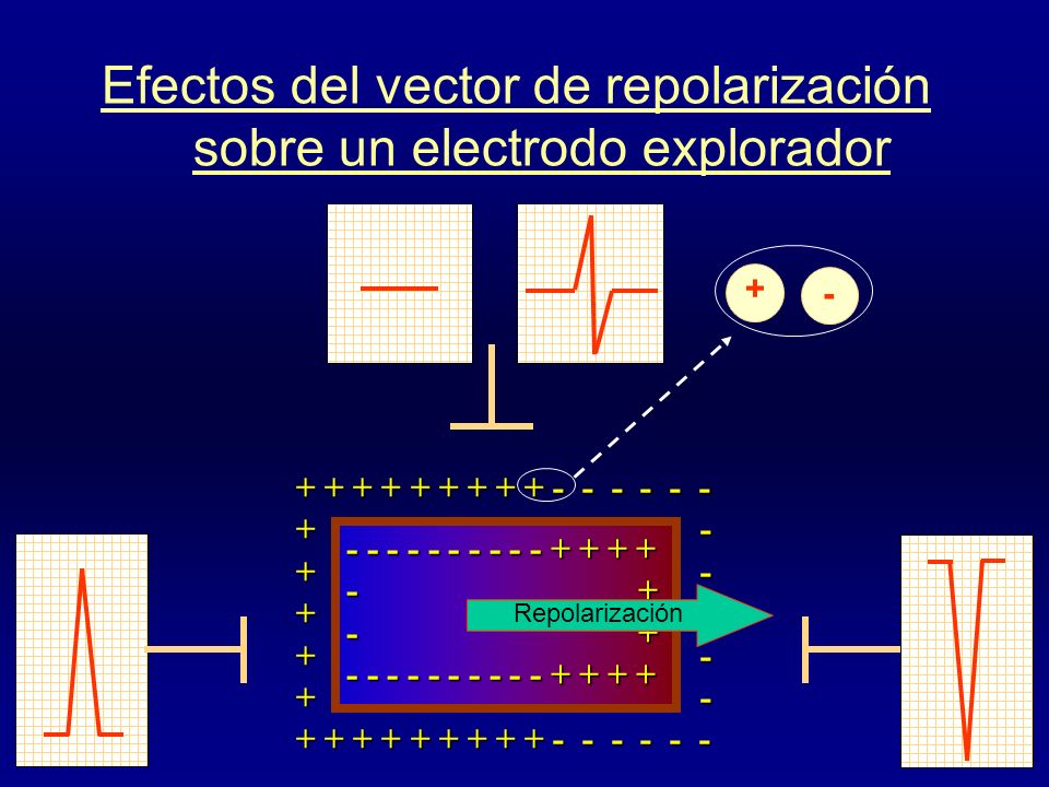 Efectos del vector de repolarización sobre un electrodo explorador