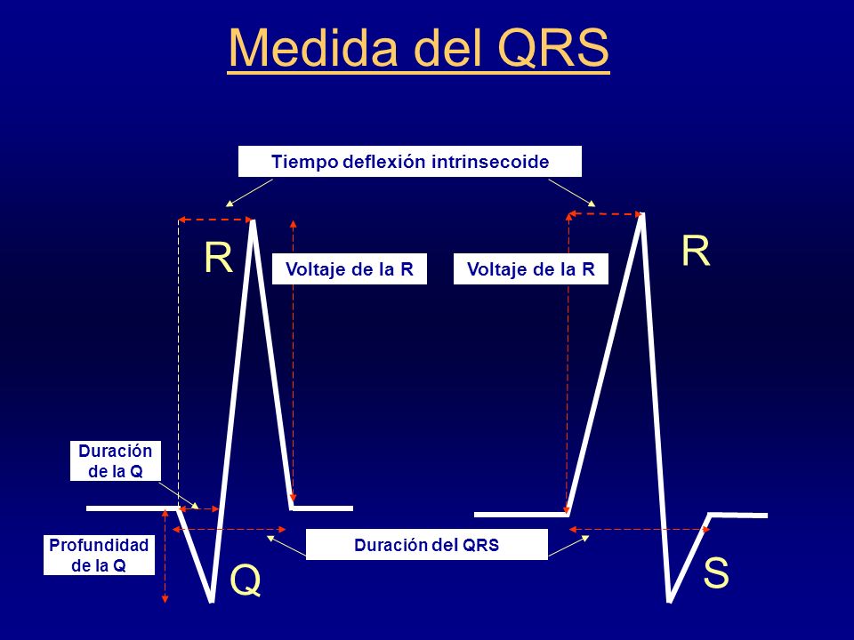 Tiempo deflexión intrinsecoide