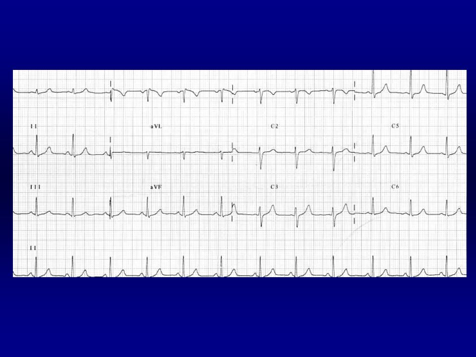 Frecuencia: 13 x 6 = 78 l.p.m. Ritmico. P: delante del QRS. Â: +60º. PR:0.13 s.