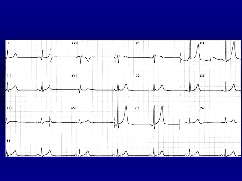 Frecuencia: 7 x 6 = 42 l.p.m. Ritmico. P: delante del QRS. Â: +60º. PR:0.11 s.