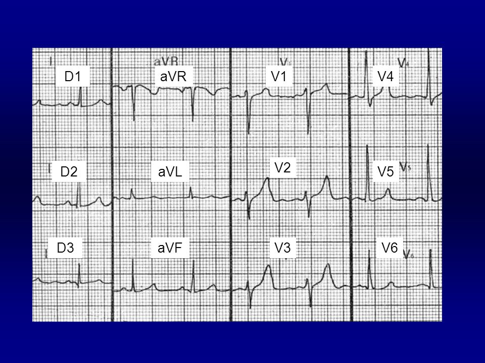 V1 V2. V3. V4. V5. V6. D1. D2. D3. aVR. aVL. aVF. Frecuencia: Si el RR mide 0,76 segundos. La frecuencia sera 60/ 0,76 = 79 l.p.m.