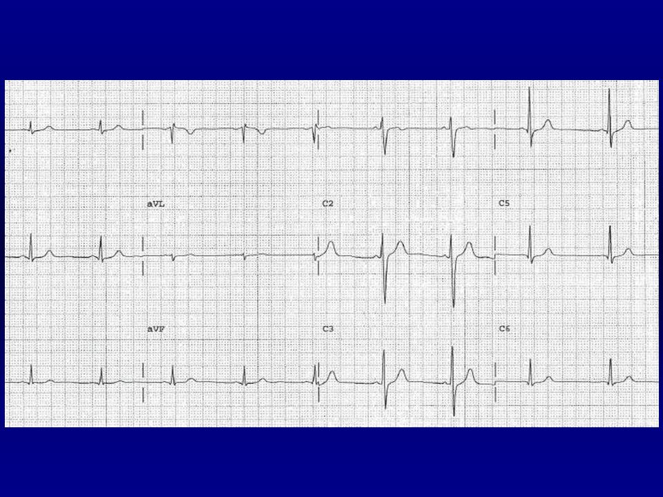 Frecuencia: 60 l.p.m. Ritmicos. P: delante del QRS. Â:+30º. PR:0.12 s.