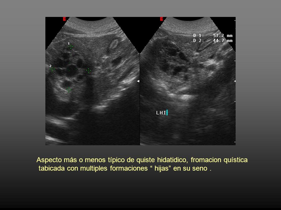 Aspecto más o menos típico de quiste hidatidico, fromacion quística