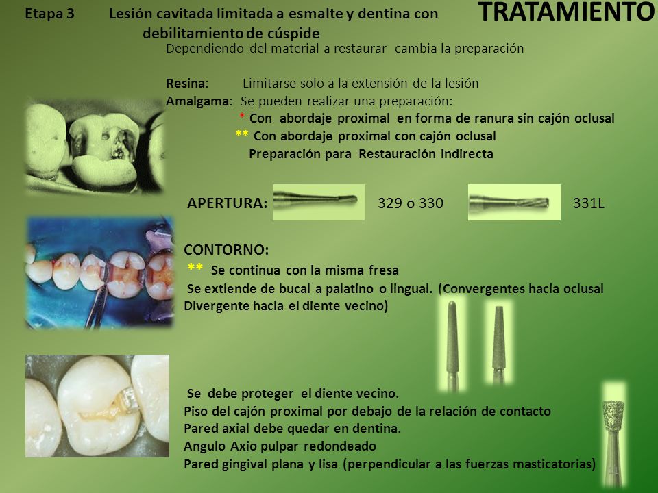 TRATAMIENTO Etapa 3 Lesión cavitada limitada a esmalte y dentina con debilitamiento de cúspide.