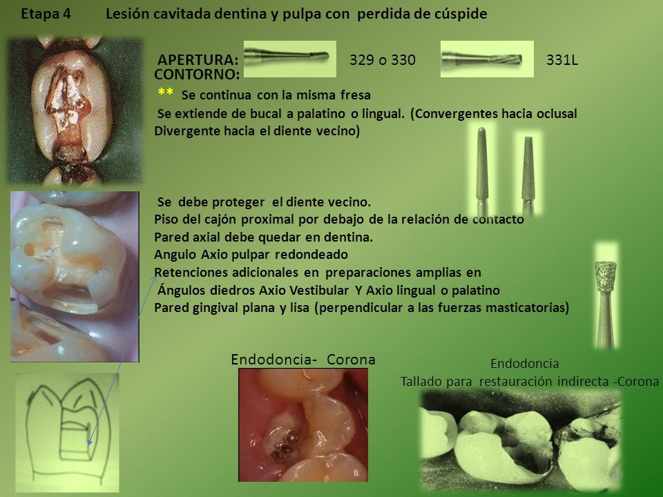 Etapa 4 Lesión cavitada dentina y pulpa con perdida de cúspide