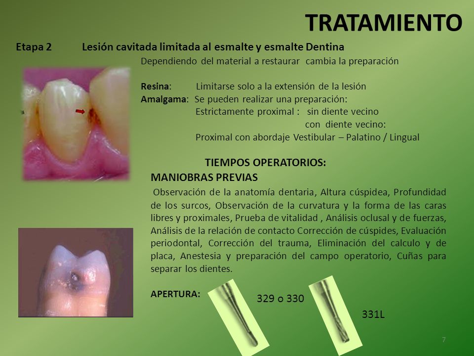 TRATAMIENTO Etapa 2 Lesión cavitada limitada al esmalte y esmalte Dentina. Dependiendo del material a restaurar cambia la preparación.