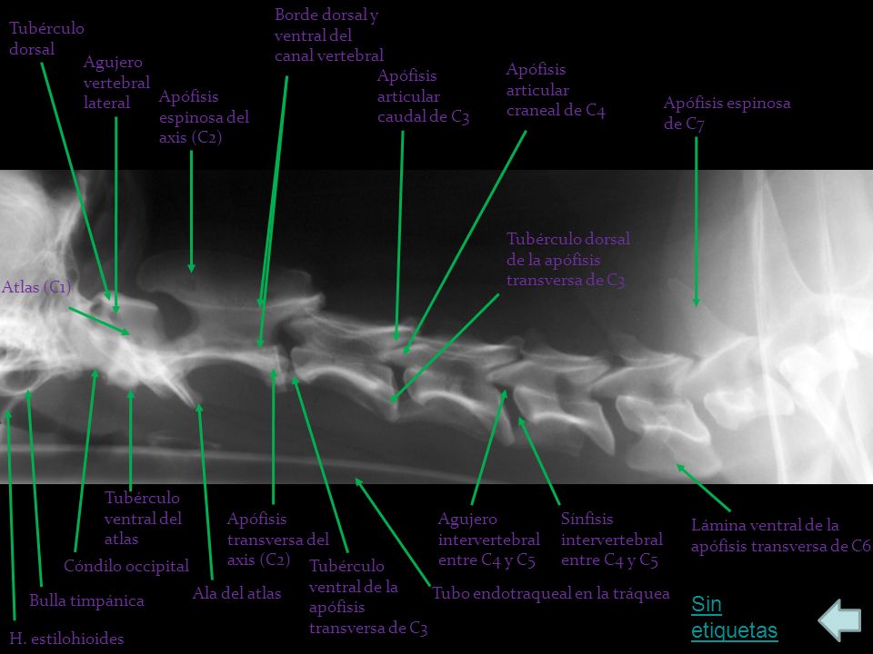 Sin etiquetas Borde dorsal y ventral del canal vertebral