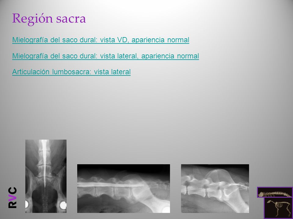 Región sacra Mielografía del saco dural: vista VD, apariencia normal