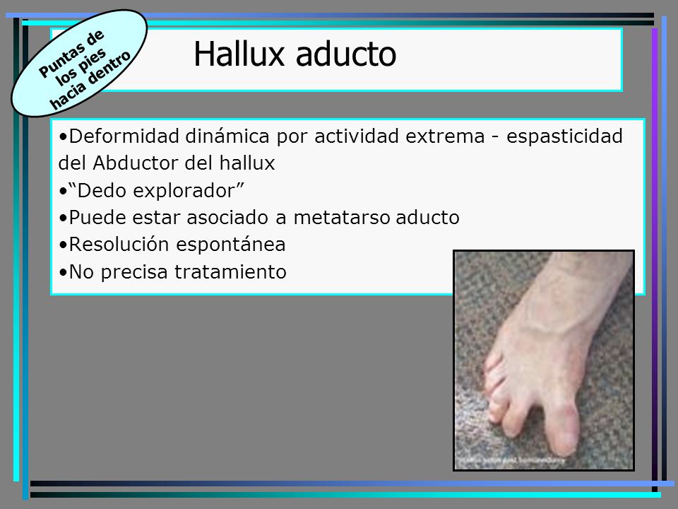 Puntas de los pies. hacia dentro. Hallux aducto. Deformidad dinámica por actividad extrema - espasticidad del Abductor del hallux.