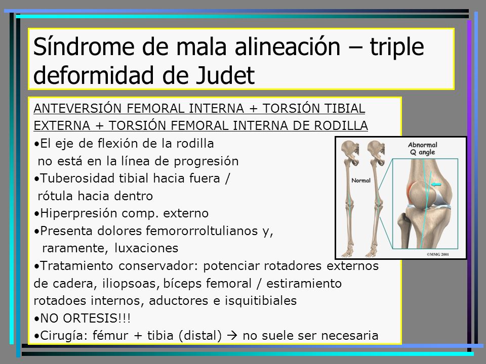 Síndrome de mala alineación – triple deformidad de Judet