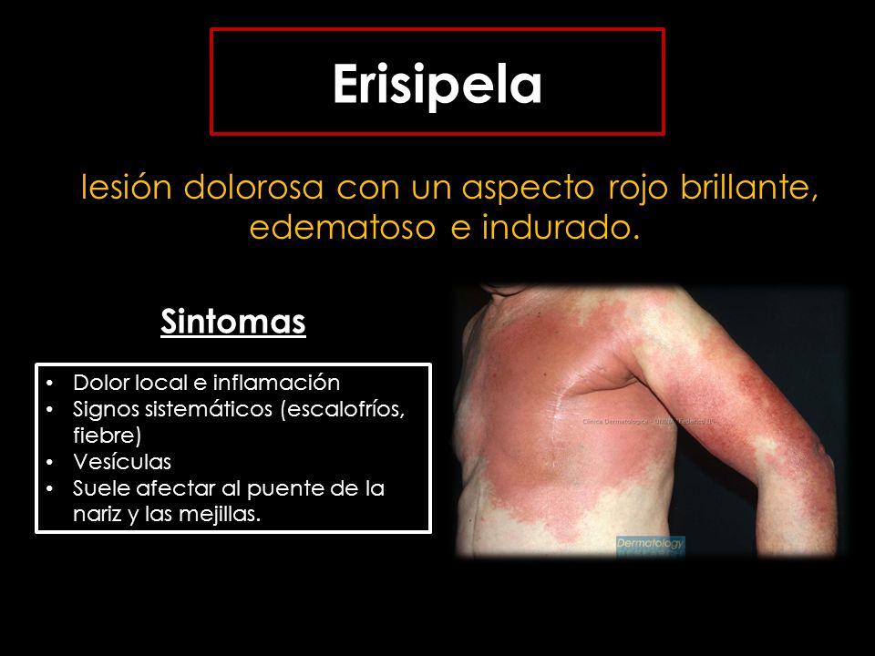 lesión dolorosa con un aspecto rojo brillante, edematoso e indurado.
