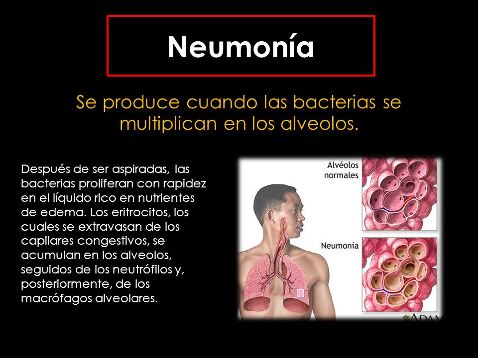 Se produce cuando las bacterias se multiplican en los alveolos.