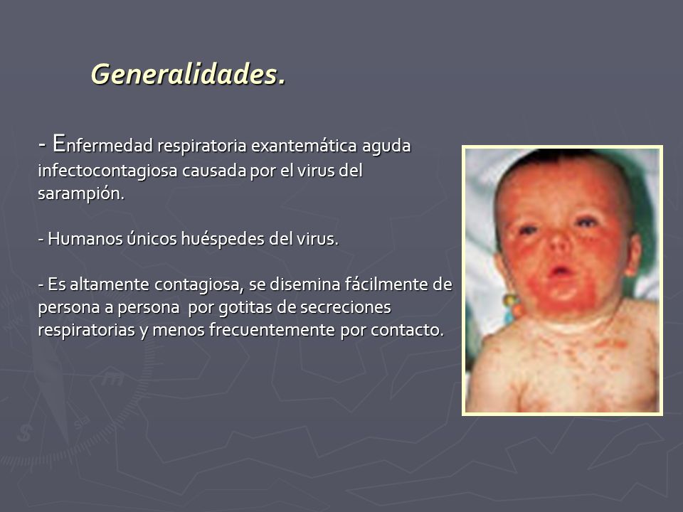 - Enfermedad respiratoria exantemática aguda infectocontagiosa causada por el virus del sarampión. - Humanos únicos huéspedes del virus. - Es altamente contagiosa, se disemina fácilmente de persona a persona por gotitas de secreciones respiratorias y menos frecuentemente por contacto.