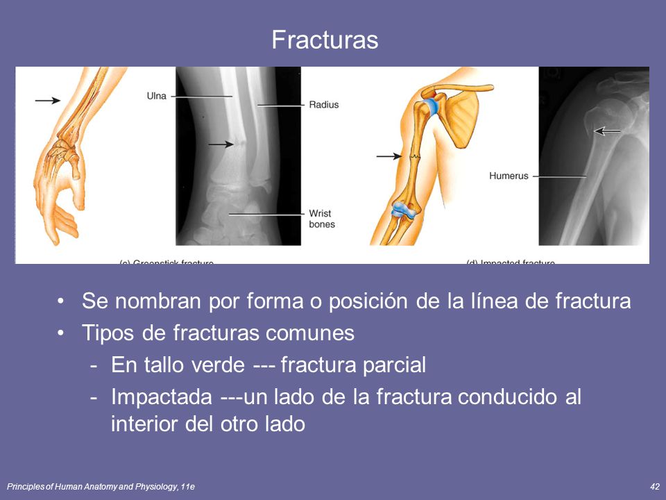 Fracturas Se nombran por forma o posición de la línea de fractura