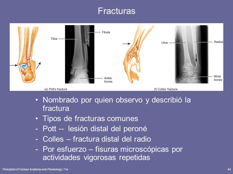 Fracturas Nombrado por quien observo y describió la fractura