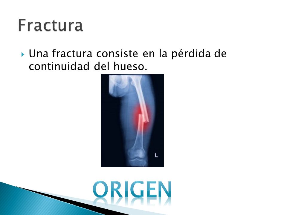 Fractura Una fractura consiste en la pérdida de continuidad del hueso. origen