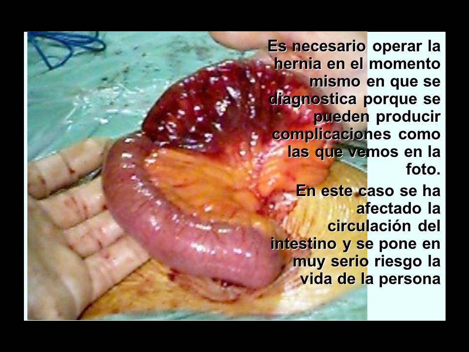 La hernia inguinal