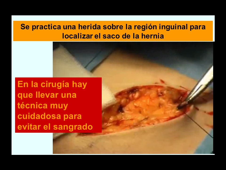 Se practica una herida sobre la región inguinal para localizar el saco de la hernia