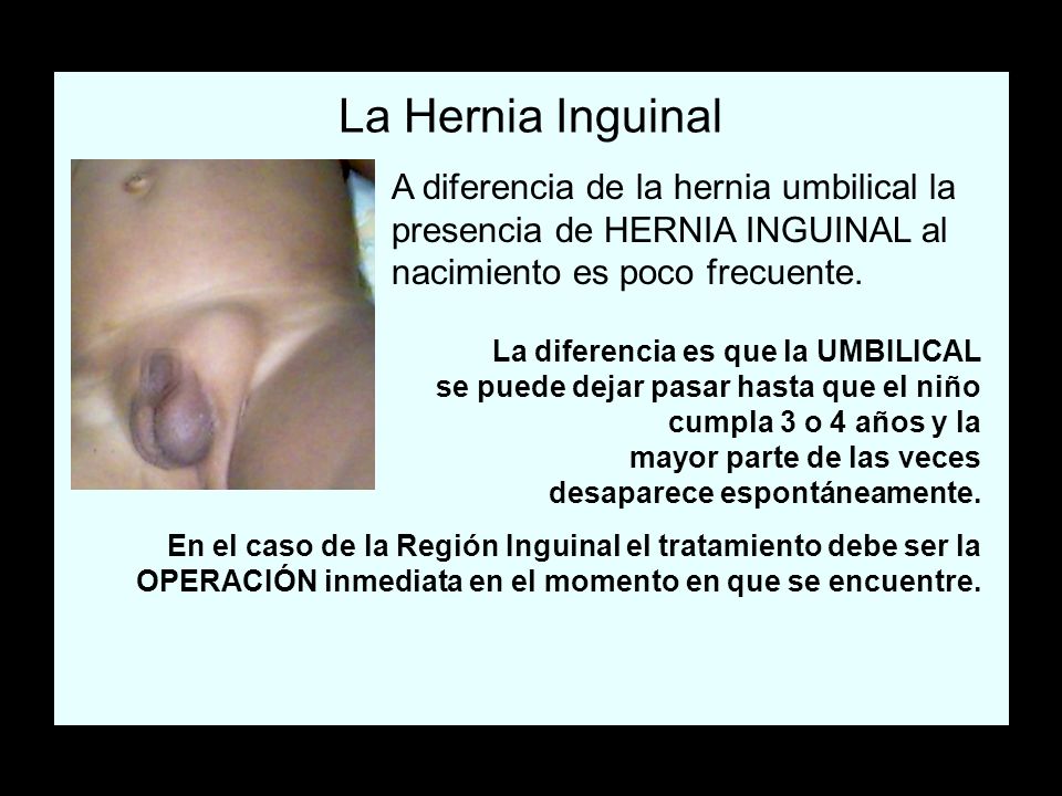 La Hernia Inguinal A diferencia de la hernia umbilical la presencia de HERNIA INGUINAL al nacimiento es poco frecuente.