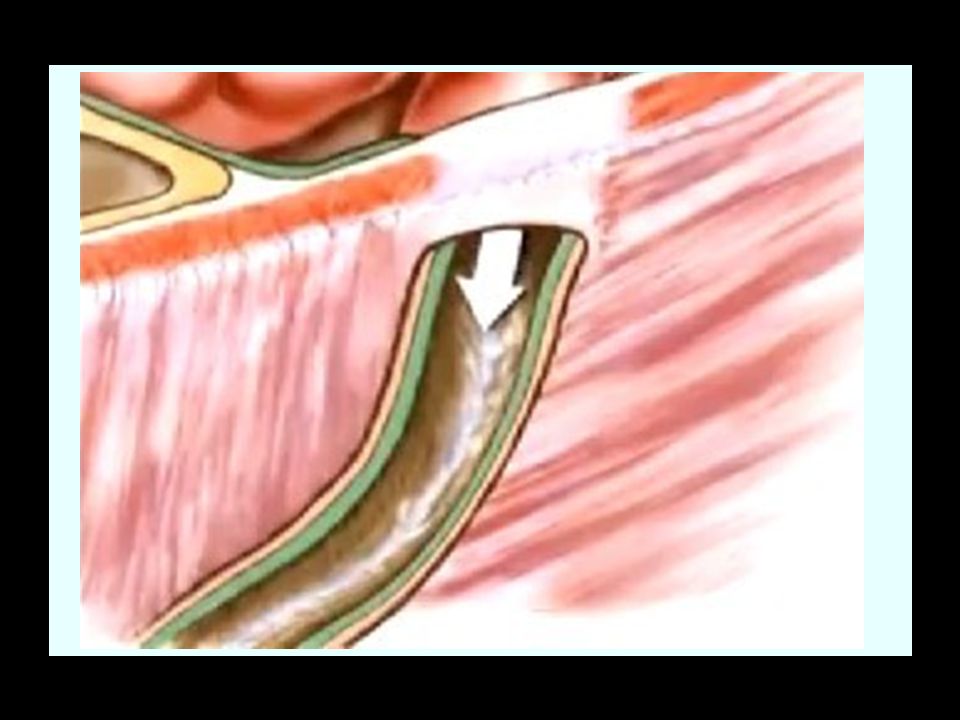 La hernia inguinal se produce generalmente como consecuencia de la persistencia de un conducto por donde descienden los testículos o su equivalente en las mujeres