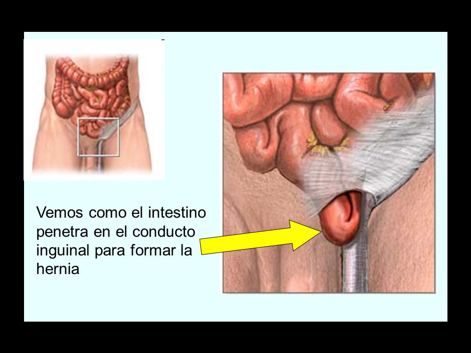 Vemos como el intestino penetra en el conducto inguinal para formar la hernia