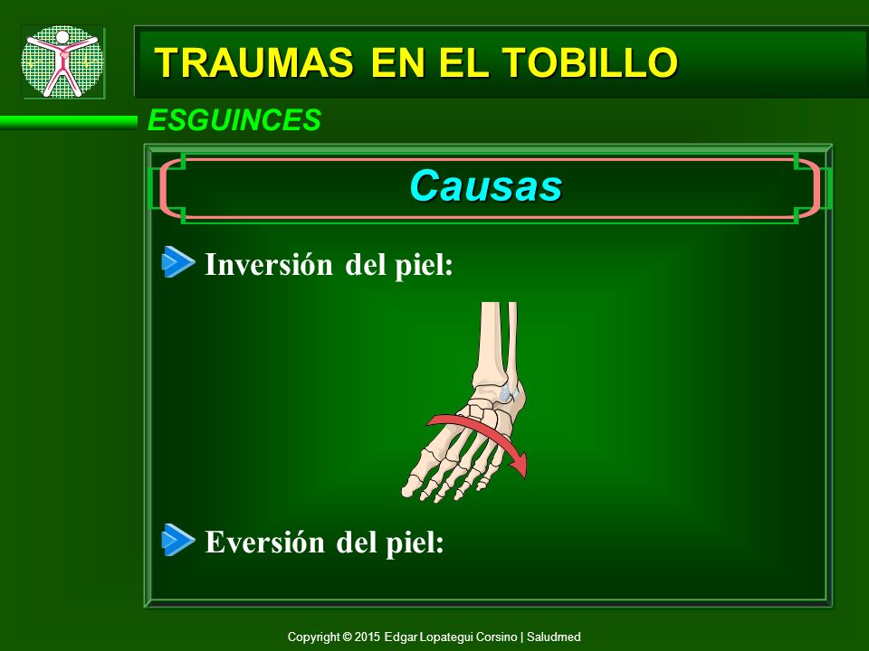 Causas TRAUMAS EN EL TOBILLO Inversión del piel: Eversión del piel: