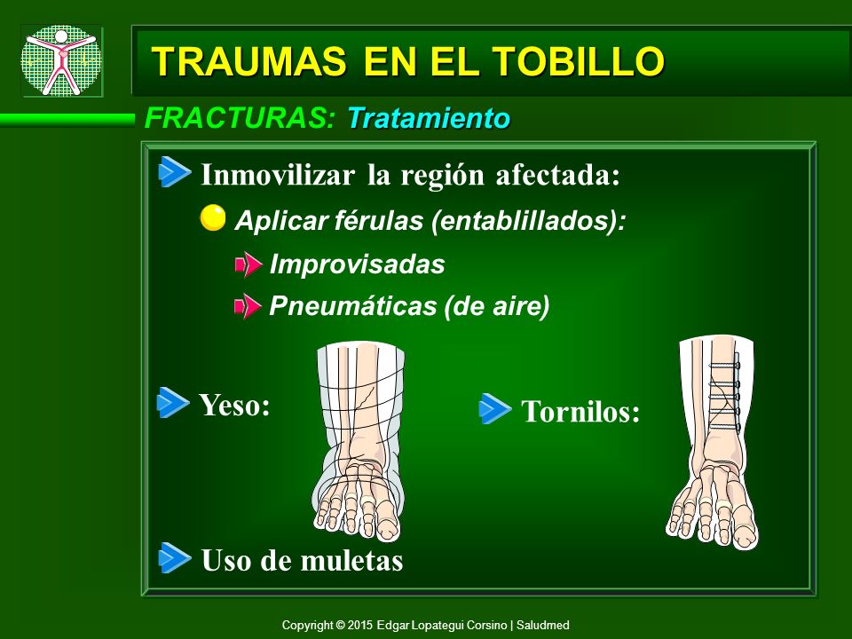 TRAUMAS EN EL TOBILLO Inmovilizar la región afectada: Yeso: Tornilos: