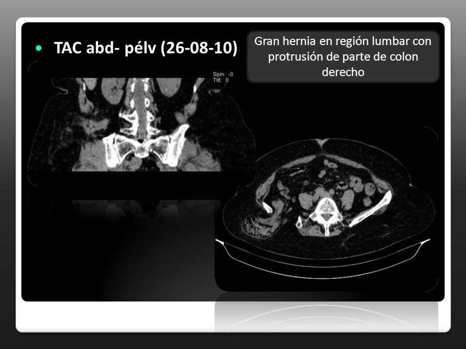 Gran hernia en región lumbar con protrusión de parte de colon derecho
