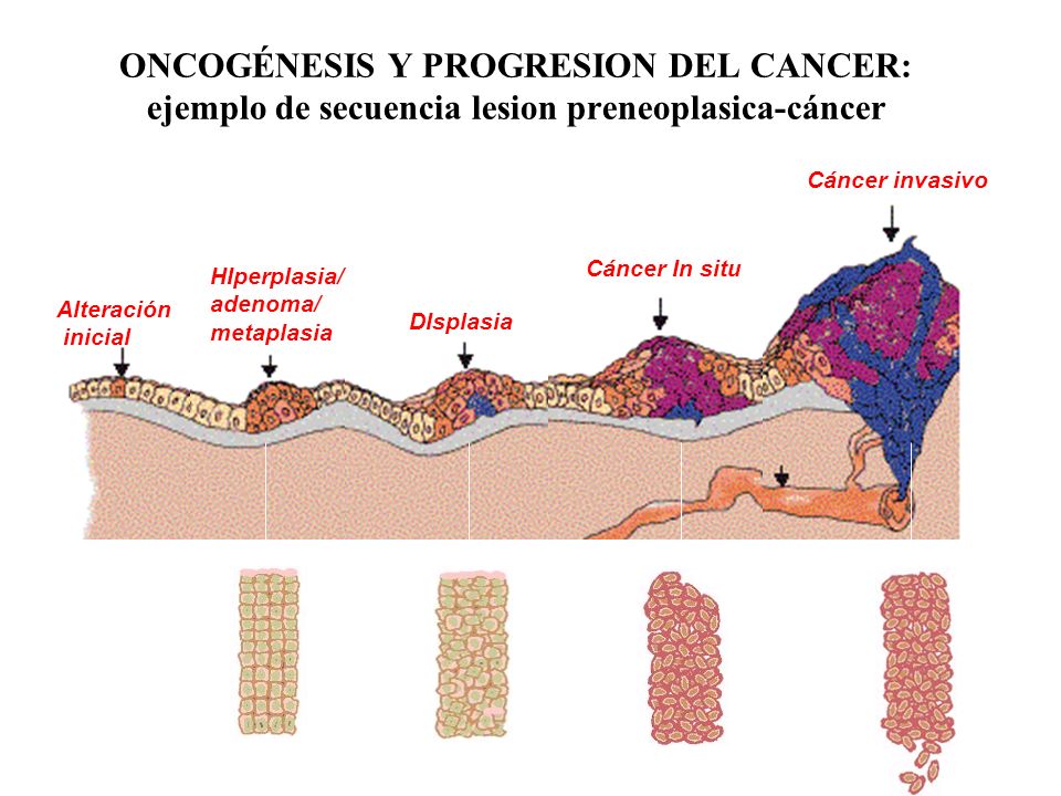 ONCOGÉNESIS Y PROGRESION DEL CANCER: ejemplo de secuencia lesion preneoplasica-cáncer