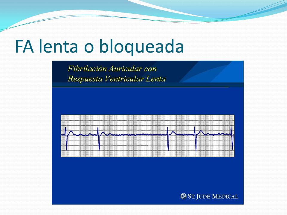 ELECTROCARDIOGRAFÍA BÁSICA EN URGENCIAS - ppt video online descargar