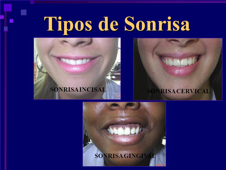 Tipos de Sonrisa SONRISA INCISAL SONRISA CERVICAL SONRISA GINGIVAL
