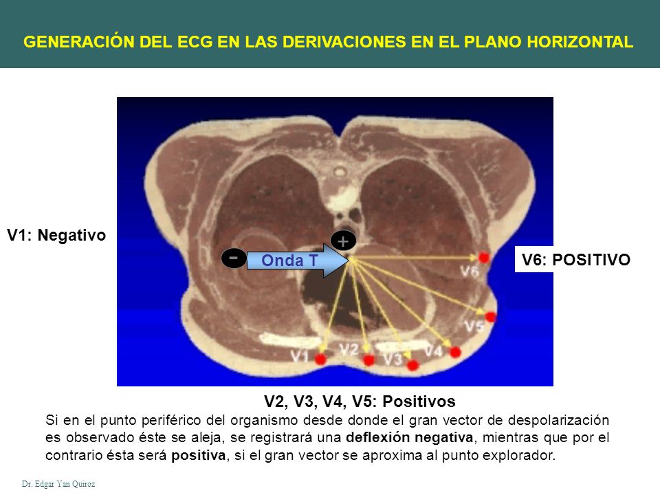- + GENERACIÓN DEL ECG EN LAS DERIVACIONES EN EL PLANO HORIZONTAL